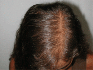 Androgenetic Alopecia